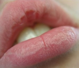 Homemade Moisture Therapy to Heal Chapped Lips